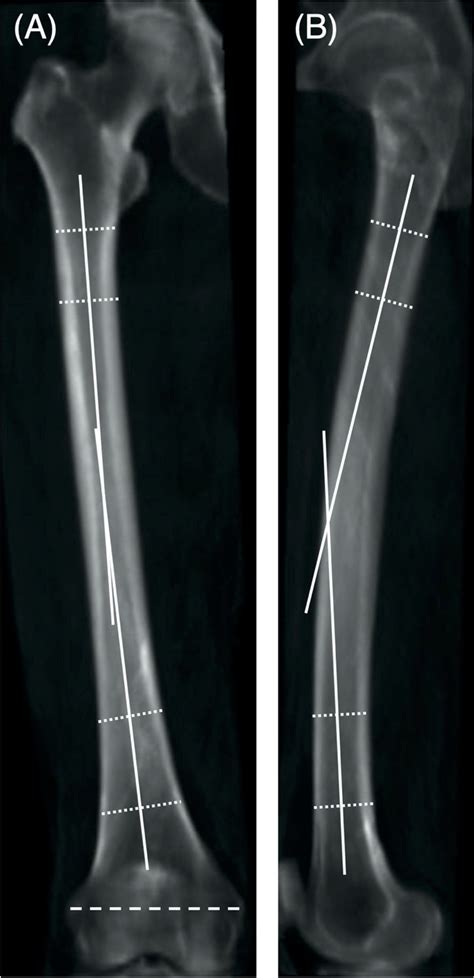 Coronal A And Sagittal B Femoral Shaft Bowing Angles Were Defined