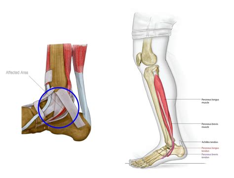 What Cardio Can I Do With Posterior Tibial Tendonitis