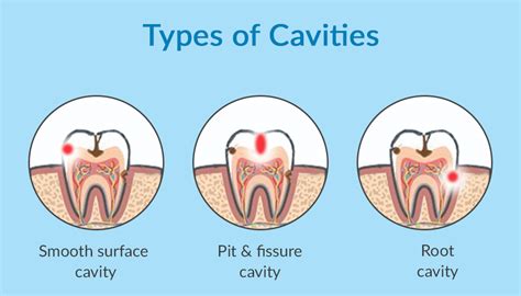 What Causes Cavities And How To Spot Tooth Decay