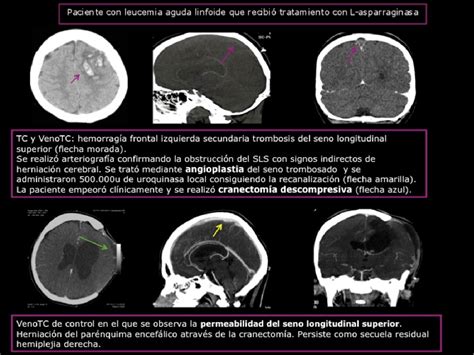 Figure 3 from Revisión de la trombosis venosa cerebral diagnóstico