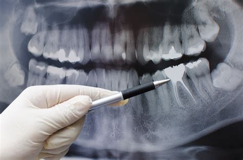 Dentist Showing Something On Dental X Ray Image Sunninghill Dental