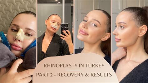 Rhinoplasty Nose Job Experience In Turkey Vlog Pt 2 Surgery Recovery