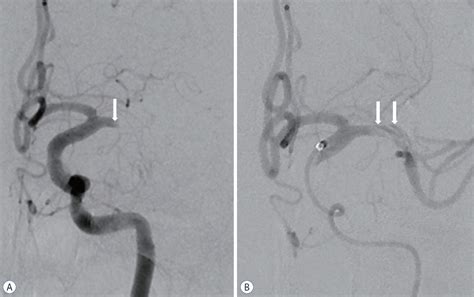 Endovascular Approach In Patients With Acute Complete Occlusion Due To