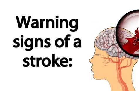 Warning Signs Of A Stroke Mindwaft