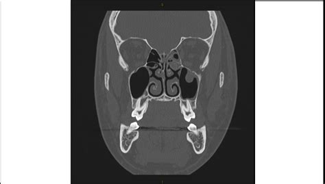 Imaging Case Of The Week 4 Emergucate