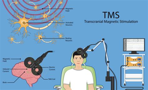Tms Therapy Recovery Unplugged