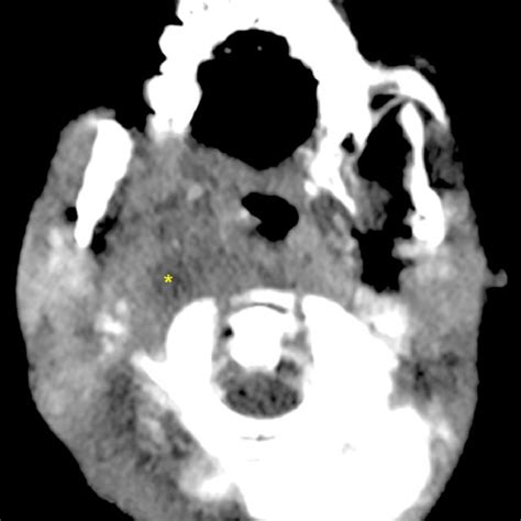 Ct Of The Neck With Contrast Shows Retropharyngeal Abscess 2 Cm X 2 Cm