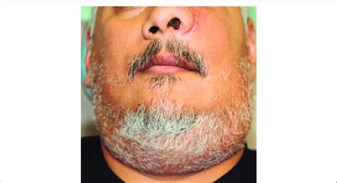 Facial Asymmetry With Prominent Left Side Swelling Distorting Left Alae