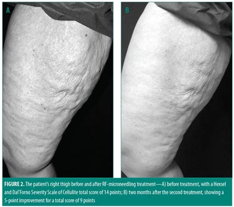 Subcutaneous Radiofrequency Microneedling For The Treatment Of Thigh