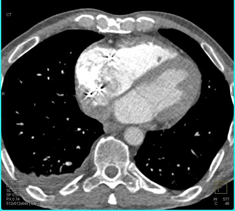 Clot In Aorta And Left Ventricle Cardiac Case Studies Ctisus Ct