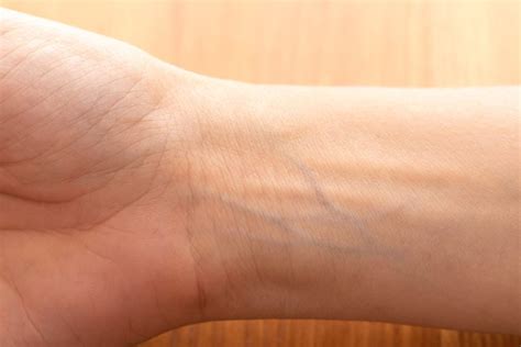 How To Make Veins Pop Out For Iv Pmcaonline