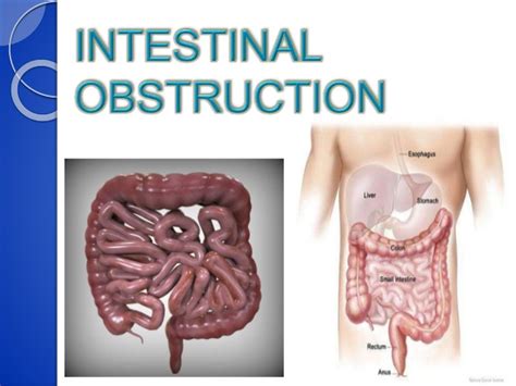 Doctors call it bowel obstruction. My Family Medicine Practice: Brief Summary of Intestinal ...