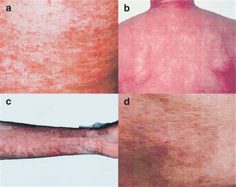 Skin Appearances Demonstrating Erythematous Papules Studded With