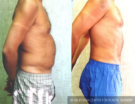 Patient Male Liposuction Abdomen Before And After Photos Beverly