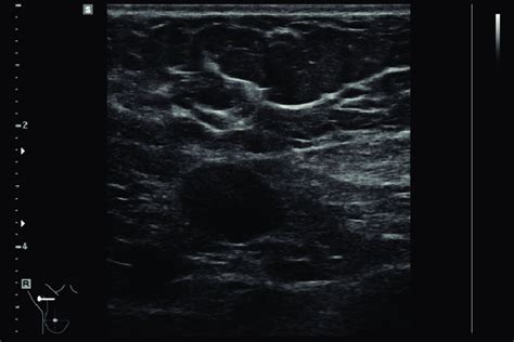 Lymph Node Without Fat Hilum And Abnormal Lt Ratio Download