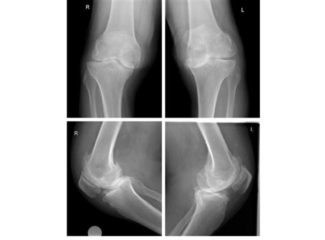 Preoperative Knee Ap And Lateral X Rays Download Scientific Diagram