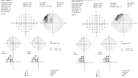 Visual Field Test Mr Anish Shah Frcophth