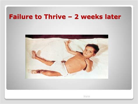 Ppt Failure To Thrive Powerpoint Presentation Free Download Id3301817