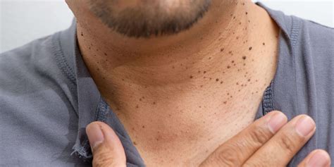 Say Goodbye To Skin Tags And Moles Painlessly Skintellect