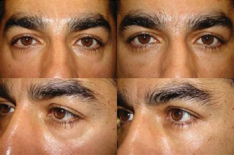 Top Frontal View And Bottom Oblique View Of Lower Lids And