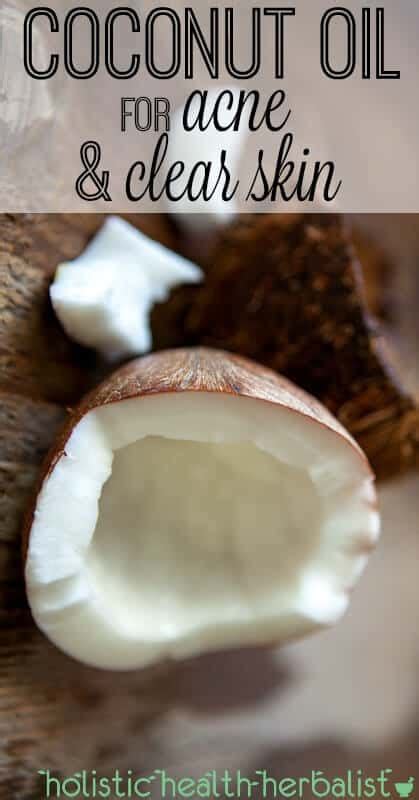 Coconut Oil For Acne And Clear Skin Holistic Health Herbalist