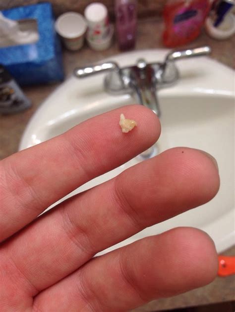 Biggest Tonsil Stone Ive Had So Far Popping