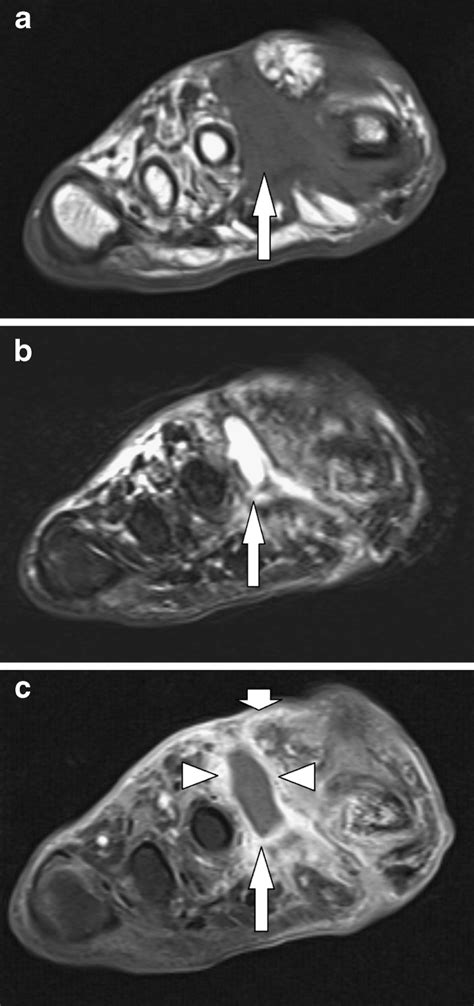 Abscess A 50 Year Old Diabetic Patient 2 Years After Amputation Of