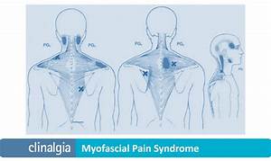 Myofascial Syndrome Lupon Gov Ph