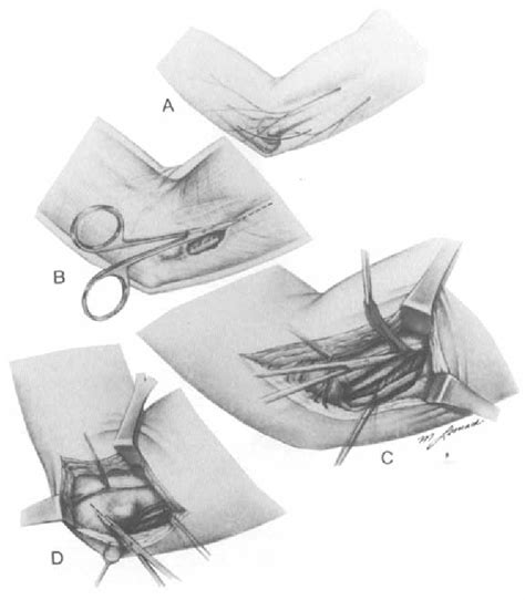 Figure 3 5 From Diagnosis And Treatment Of Ulnar Nerve Compression At