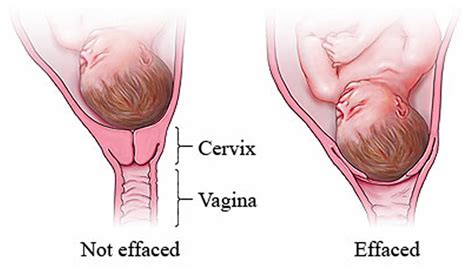 Cervical Effacement Cervix Thinning And Signs Your Cervix Is Thinning