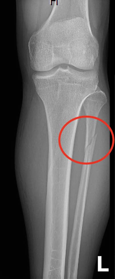 Ortho Pearls The Maisonneuve Fracture — Cook County Emergency
