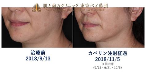 症例写真 カベリン 二重あごや顔周りの脂肪がずっと気になっていた50代女性 肌と歯のクリニック 東京ベイ幕張 千葉 美容皮膚科