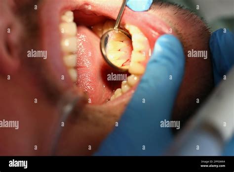 Dentist Examines Male Teeth And Inflamed Gums With Mirror Stock Photo