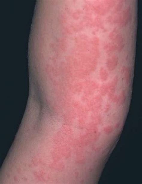 Learn how to prevent them, and how you can treat an allergic rash naturally. Tomato Allergy Rash Pictures