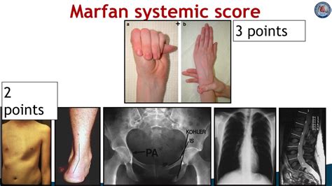 Marfan Syndrome Diagnosis
