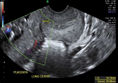 Cervical Length Measurement Comparison Of Transabdominal And