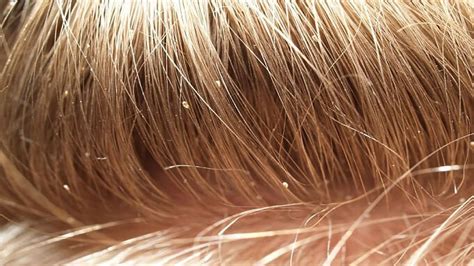 Head Lice Causes Diagnosis Prevention And Treatment