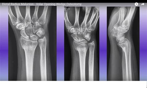 Volar Opening Wedge Osteotomy For Distal Radius Malunion