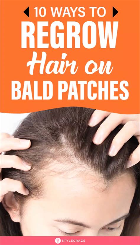 10 Home Remedies To Regrow Hair On Bald Patches Artofit