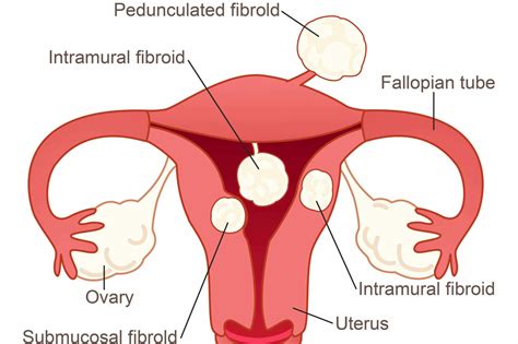 A Simple Guide To Fibroids Nabtahealth Womens Health And Wellness