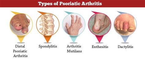 Pin On Psoriasis Psoriasic Arthritis And Co