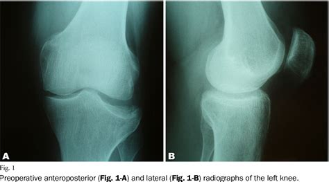 Figure 1 From Reconstruction Of A Neglected Tibial Plateau Fracture