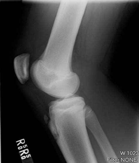 Adolescent With Knee Pain Aafp