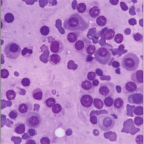 Bone Marrow Aspirate Showing Involvement By Multiple Myeloma With Many Download Scientific