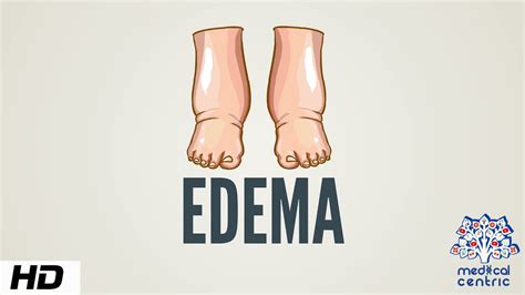Edema Causes Signs And Symptoms Diagnosis And Treatment Youtube