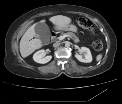 Accessory Gallbladder A New Anatomical Variation Arising From Both