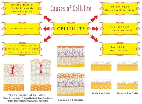What Causes Cellulite Find Out Why You Have Cellulite