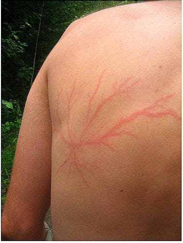 This is what you body looks like after however, this is what lightning scars look like in the case you're alive. #EasyNip | Lightning scar, Scar, Lichtenberg