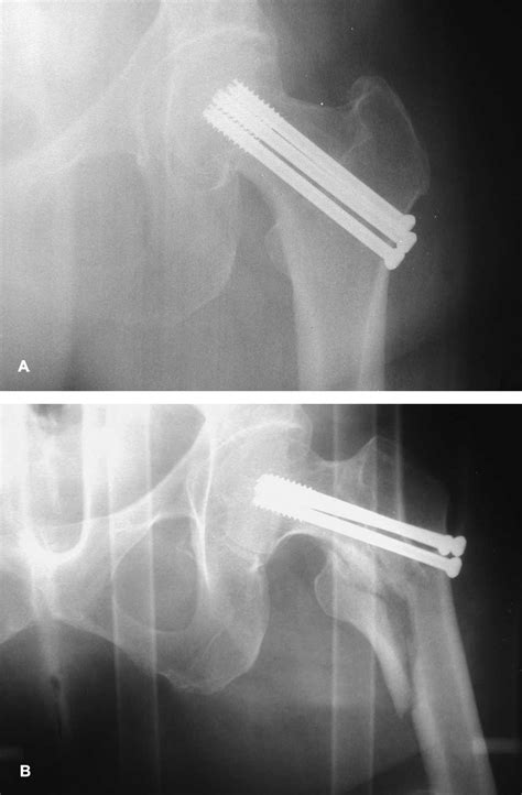 A B A An Ap Radiograph Shows A Garden I Femoral Neck Fracture After