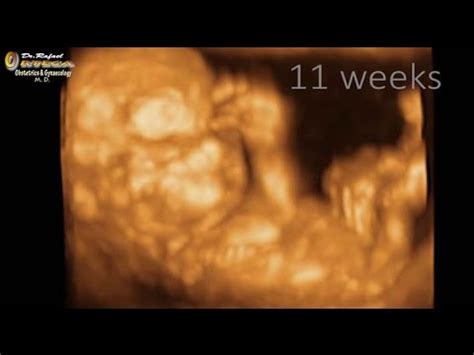 This test will also show. 3D ultrasound pregnancy 11 weeks fetal bone Rafael Ortega ...